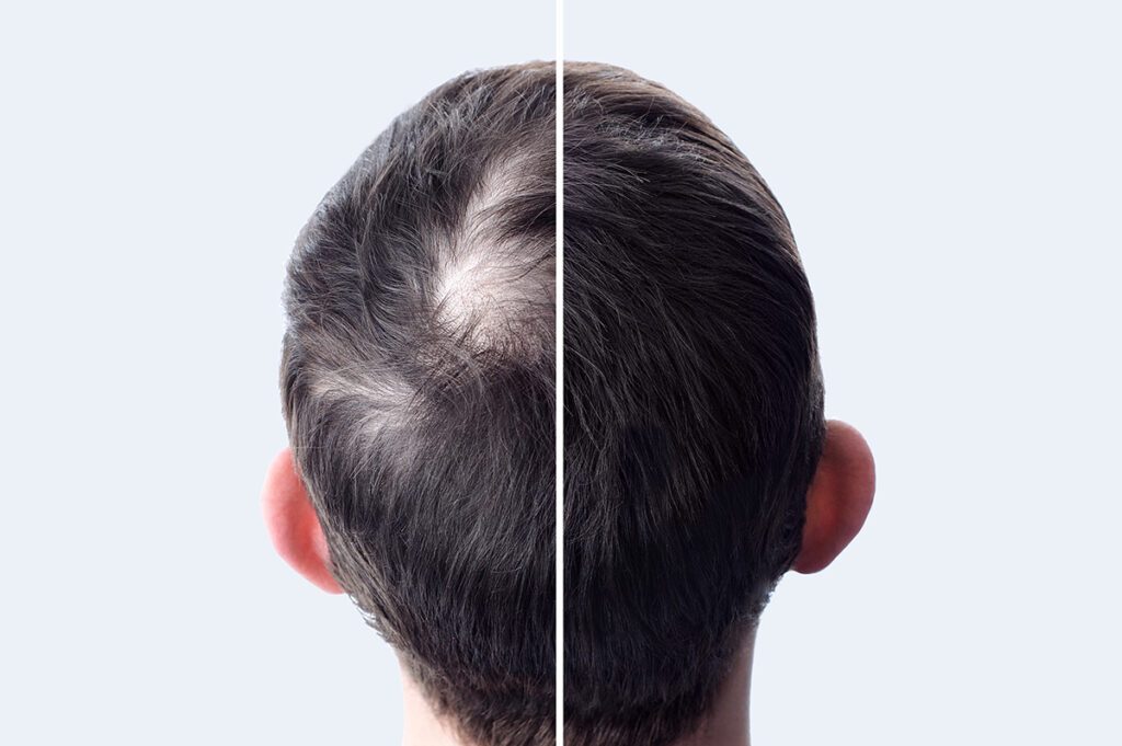 Prevention Regrowth